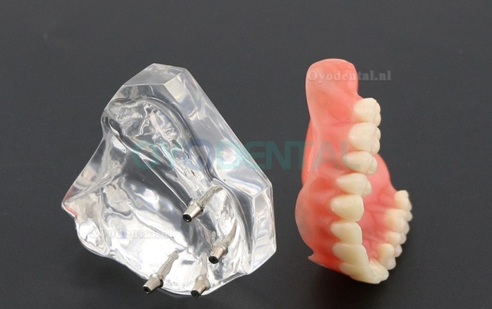 Tandheelkundige studie Tanden Model Overdenture met 4 implantaten Demo Model 6001